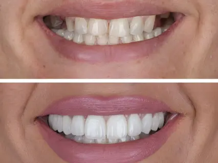 cosmetic teeth bonding 