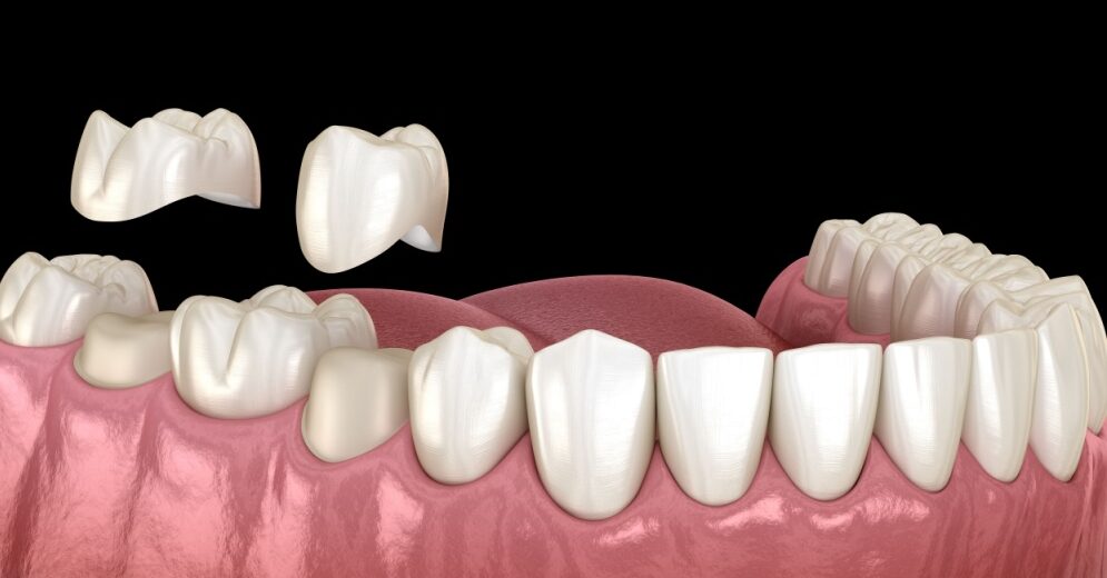 dental crowns