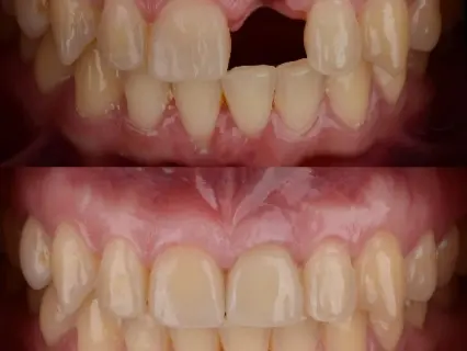 dental bridges