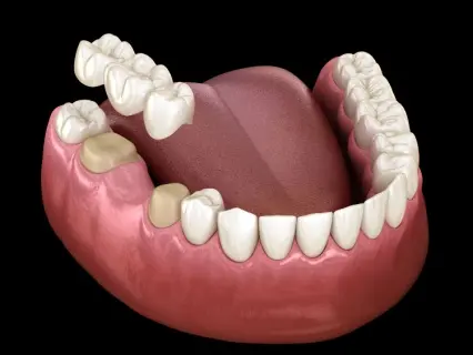 dental bridges 