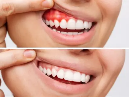 gum disease treatment