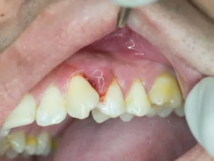 gum disease treatment