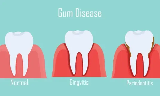 gum disease treatment