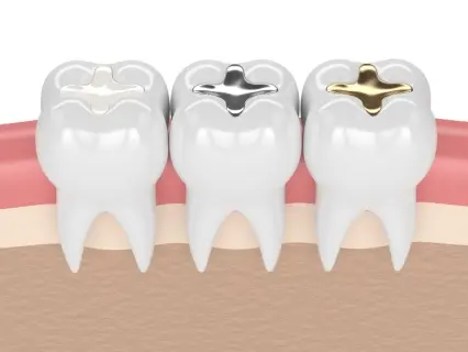 tooth-colored fillings